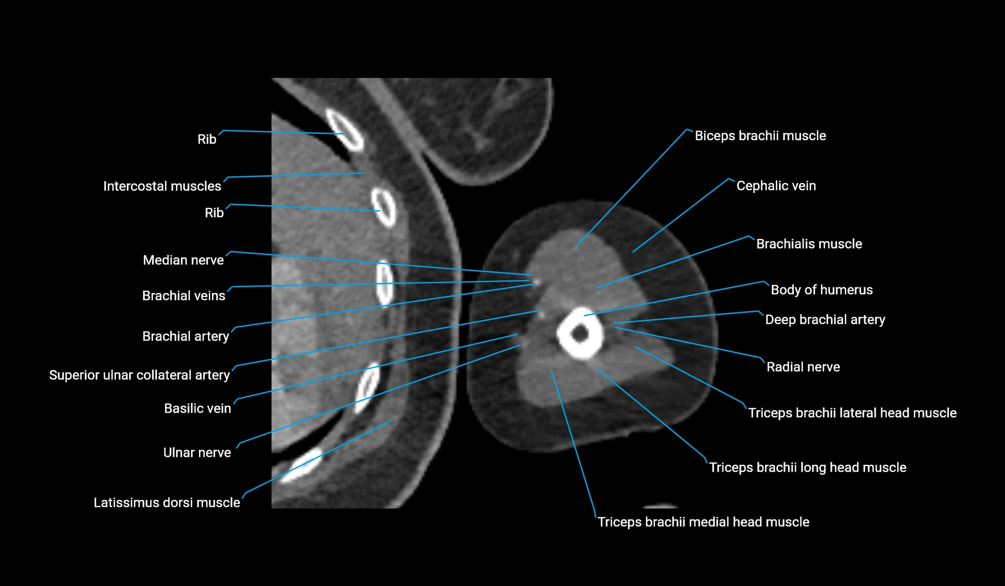 CT upper arm axial  cross sectional anatomy labelled radiology image -00284.webp